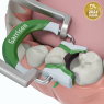 GARRISON COMPOSI-TIGHT 3D FUSION SECTIONAL MATRIX KIT
